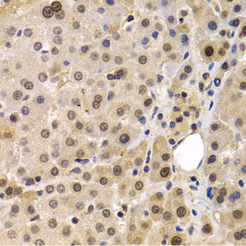 MAGEA1 / MAGE 1 Antibody - Immunohistochemistry of paraffin-embedded human liver cancer tissue.
