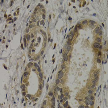 MAGEA1 / MAGE 1 Antibody - Immunohistochemistry of paraffin-embedded human stomach cancer tissue.