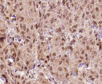 MAGEA1 / MAGE 1 Antibody - 1:100 staining human breast carcinoma tissue by IHC-P. The tissue was formaldehyde fixed and a heat mediated antigen retrieval step in citrate buffer was performed. The tissue was then blocked and incubated with the antibody for 1.5 hours at 22°C. An HRP conjugated goat anti-rabbit antibody was used as the secondary.