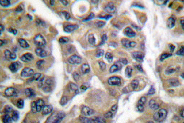MAGEA1 / MAGE 1 Antibody - IHC of MAGE-1/Tumor antigen MAGE-N (F293) pAb in paraffin-embedded human breast carcinoma tissue.