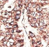 MAGEA11 Antibody - Formalin-fixed and paraffin-embedded human cancer tissue reacted with the primary antibody, which was peroxidase-conjugated to the secondary antibody, followed by DAB staining. This data demonstrates the use of this antibody for immunohistochemistry; clinical relevance has not been evaluated. BC = breast carcinoma; HC = hepatocarcinoma.