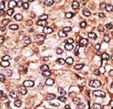 MAGEA2 Antibody - Formalin-fixed and paraffin-embedded human cancer tissue reacted with the primary antibody, which was peroxidase-conjugated to the secondary antibody, followed by AEC staining. This data demonstrates the use of this antibody for immunohistochemistry; clinical relevance has not been evaluated. BC = breast carcinoma; HC = hepatocarcinoma.