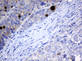 MAGEA3 Antibody - IHC of paraffin-embedded Adenocarcinoma of Human colon tissue using anti-MAGEA3 mouse monoclonal antibody. (Heat-induced epitope retrieval by 10mM citric buffer, pH6.0, 120°C for 3min).