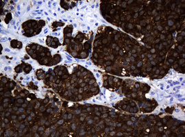 MAGEA3 Antibody - IHC of paraffin-embedded Carcinoma of Human lung tissue using anti-MAGEA3 mouse monoclonal antibody.