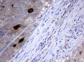 MAGEA3 Antibody - IHC of paraffin-embedded Adenocarcinoma of Human colon tissue using anti-MAGEA3 mouse monoclonal antibody.