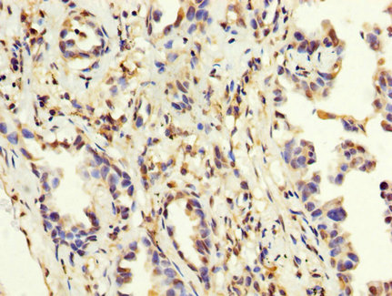 MAGEA3 Antibody - Immunohistochemistry image at a dilution of 1:200 and staining in paraffin-embedded human lung cancer performed on a Leica BondTM system. After dewaxing and hydration, antigen retrieval was mediated by high pressure in a citrate buffer (pH 6.0) . Section was blocked with 10% normal goat serum 30min at RT. Then primary antibody (1% BSA) was incubated at 4 °C overnight. The primary is detected by a biotinylated secondary antibody and visualized using an HRP conjugated SP system.
