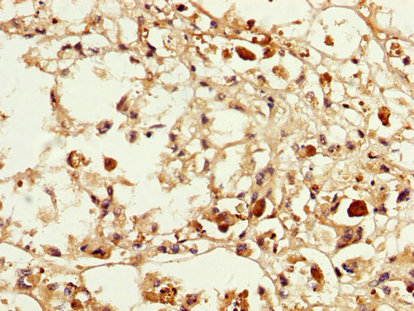 MAGEA3 Antibody - Immunohistochemistry image at a dilution of 1:200 and staining in paraffin-embedded human melanoma cancer performed on a Leica BondTM system. After dewaxing and hydration, antigen retrieval was mediated by high pressure in a citrate buffer (pH 6.0) . Section was blocked with 10% normal goat serum 30min at RT. Then primary antibody (1% BSA) was incubated at 4 °C overnight. The primary is detected by a biotinylated secondary antibody and visualized using an HRP conjugated SP system.