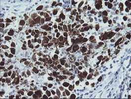 MAGEA4 Antibody - IHC of paraffin-embedded Carcinoma of Human bladder tissue using anti-MAGEA4 mouse monoclonal antibody. (Heat-induced epitope retrieval by 10mM citric buffer, pH6.0, 120°C for 3min).