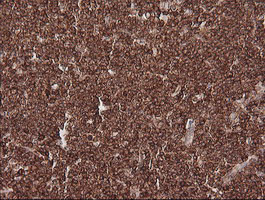 MAGEA4 Antibody - IHC of paraffin-embedded Human lymphoma tissue using anti-MAGEA4 mouse monoclonal antibody.