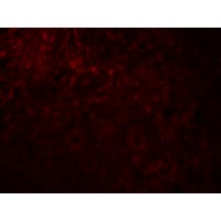 MAGEA4 Antibody - Immunofluorescence of MAGEA4 in human breast cancer tissue with MAGEA4 antibody at 20 µg/ml.