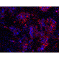 MAGEA4 Antibody - Immunofluorescence of MAGEA4 in human breast cancer tissue with MAGEA4 antibody at 20 µg/ml.