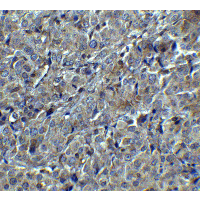 MAGEA4 Antibody - Immunohistochemistry of MAGEA4 in human breast tumor with MAGEA4 antibody at 5 µg/mL.