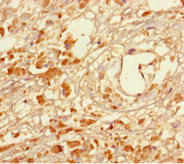 MAGEA5 Antibody - Immunohistochemistry of paraffin-embedded human melanoma using MAGEA5 Antibody at dilution of 1:100
