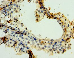MAGEA6 Antibody - Immunohistochemistry of paraffin-embedded human lung cancer using antibody at 1:100 dilution.