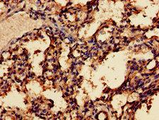 MAGEA8 Antibody - Immunohistochemistry of paraffin-embedded human breast cancer using MAGEA8 Antibody at dilution of 1:100