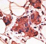 MAGEA9 Antibody - Formalin-fixed and paraffin-embedded human cancer tissue reacted with the primary antibody, which was peroxidase-conjugated to the secondary antibody, followed by AEC staining. This data demonstrates the use of this antibody for immunohistochemistry; clinical relevance has not been evaluated. BC = breast carcinoma; HC = hepatocarcinoma.