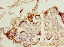 MAGEA9 Antibody - Immunohistochemistry of paraffin-embedded human breast cancer using antibody at dilution of 1:100.