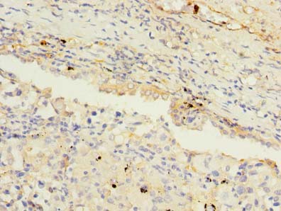MAGEA9 Antibody - Immunohistochemistry of paraffin-embedded human lung cancer using antibody at dilution of 1:100.