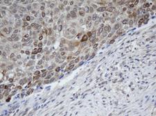 MAGEB1 Antibody - IHC of paraffin-embedded Carcinoma of Human bladder tissue using anti-MAGEB1 mouse monoclonal antibody.