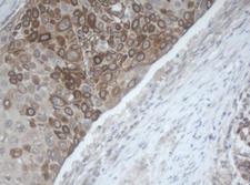 MAGEB1 Antibody - IHC of paraffin-embedded Carcinoma of Human bladder tissue using anti-MAGEB1 mouse monoclonal antibody.