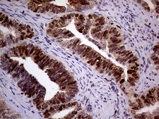 MAGEB4 Antibody - Immunohistochemical staining of paraffin-embedded Adenocarcinoma of Human endometrium tissue using anti-MAGEB4 mouse monoclonal antibody. (Heat-induced epitope retrieval by 1mM EDTA in 10mM Tris buffer. (pH8.5) at 120°C for 3 min. (1:500)