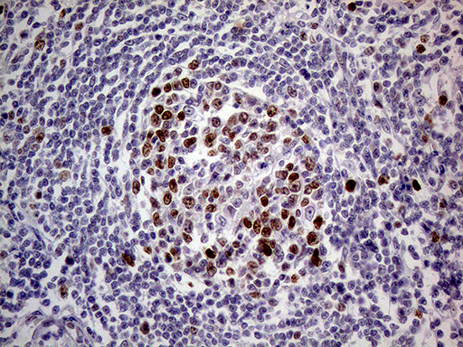 MAGEB4 Antibody - Immunohistochemical staining of paraffin-embedded Human lymph node tissue within the normal limits using anti-MAGEB4 mouse monoclonal antibody. (Heat-induced epitope retrieval by 1mM EDTA in 10mM Tris buffer. (pH8.5) at 120°C for 3 min. (1:500)