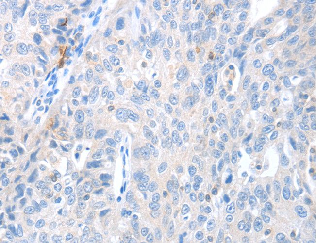MAGEB4 Antibody - Immunohistochemistry of paraffin-embedded Human ovarian cancer using MAGEB4 Polyclonal Antibody at dilution of 1:40.