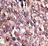 MAGEC1 Antibody - Formalin-fixed and paraffin-embedded human cancer tissue reacted with the primary antibody, which was peroxidase-conjugated to the secondary antibody, followed by AEC staining. This data demonstrates the use of this antibody for immunohistochemistry; clinical relevance has not been evaluated. BC = breast carcinoma; HC = hepatocarcinoma.