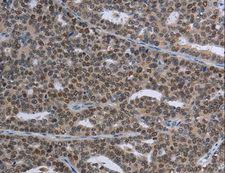 MAGEC1 Antibody - Immunohistochemistry of paraffin-embedded Human thyroid cancer using MAGEC1 Polyclonal Antibody at dilution of 1:30.