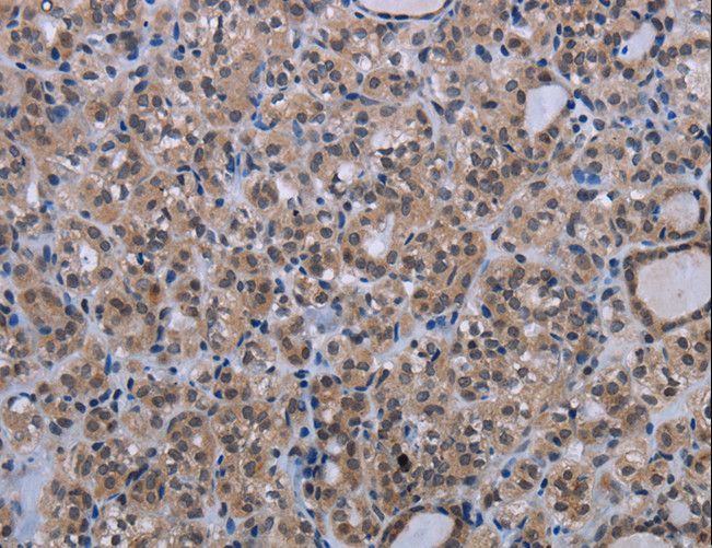 MAGEC1 Antibody - Immunohistochemistry of paraffin-embedded Human thyroid cancer using MAGEC1 Polyclonal Antibody at dilution of 1:30.