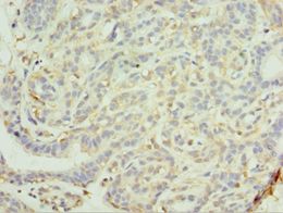 MAGEC2 / CT10 Antibody - Immunohistochemistry of paraffin-embedded human breast cancer using antibody at 1:100 dilution.