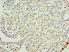 MAGEC2 / CT10 Antibody - Immunohistochemistry of paraffin-embedded human breast cancer using antibody at 1:100 dilution.