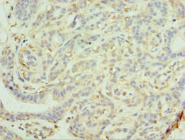 MAGEC2 / CT10 Antibody - Immunohistochemistry of paraffin-embedded human breast cancer using MAGEC2 Antibody at dilution of 1:100