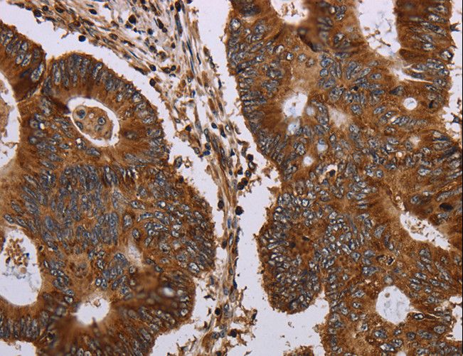 MAGEC2 / CT10 Antibody - Immunohistochemistry of paraffin-embedded Human liver cancer using MAGEC2 Polyclonal Antibody at dilution of 1:40.