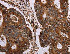 MAGEC2 / CT10 Antibody - Immunohistochemistry of paraffin-embedded Human liver cancer using MAGEC2 Polyclonal Antibody at dilution of 1:40.