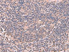 MAGEC2 / CT10 Antibody - Immunohistochemistry of paraffin-embedded Human cervical cancer tissue  using MAGEC2 Polyclonal Antibody at dilution of 1:60(×200)