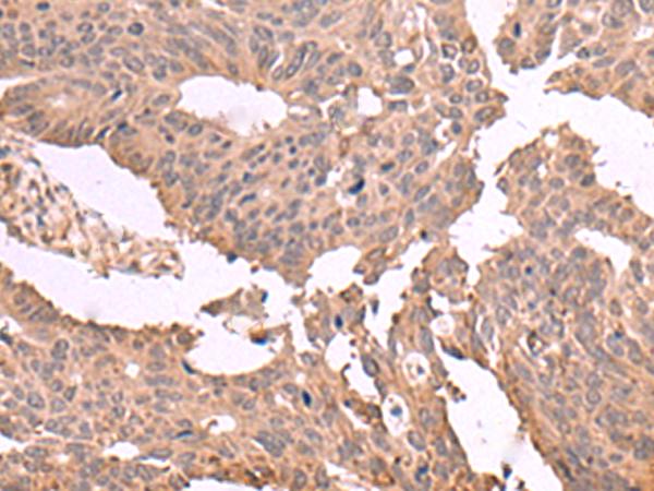 MAGEC2 / CT10 Antibody - Immunohistochemistry of paraffin-embedded Human colorectal cancer tissue  using MAGEC2 Polyclonal Antibody at dilution of 1:60(×200)