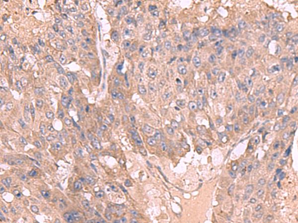 MAGEC2 / CT10 Antibody - Immunohistochemistry of paraffin-embedded Human liver cancer tissue  using MAGEC2 Polyclonal Antibody at dilution of 1:50(×200)