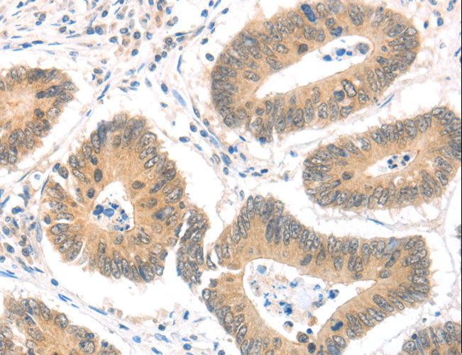 MAGED1 / NRAGE Antibody - Immunohistochemistry of paraffin-embedded Human colon cancer using MAGED1 Polyclonal Antibody at dilution of 1:30.