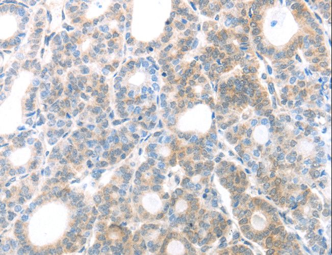 MAGED1 / NRAGE Antibody - Immunohistochemistry of paraffin-embedded Human thyroid cancer using MAGED1 Polyclonal Antibody at dilution of 1:30.