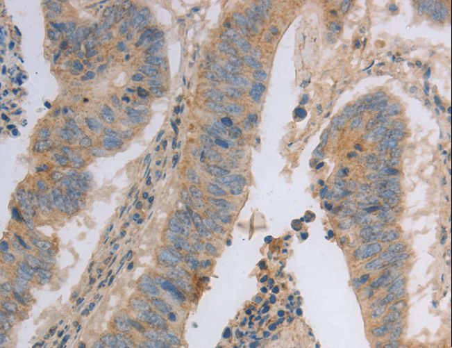 MAGED1 / NRAGE Antibody - Immunohistochemistry of paraffin-embedded Human colon cancer using MAGED1 Polyclonal Antibody at dilution of 1:30.