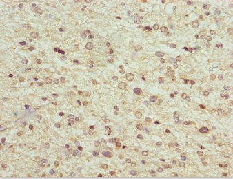 MAGED1 / NRAGE Antibody - Immunohistochemistry of paraffin-embedded human glioma cancer at dilution 1:100