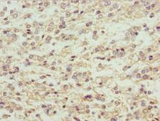 MAGED1 / NRAGE Antibody - Immunohistochemistry of paraffin-embedded human glioma cancer at dilution 1:100