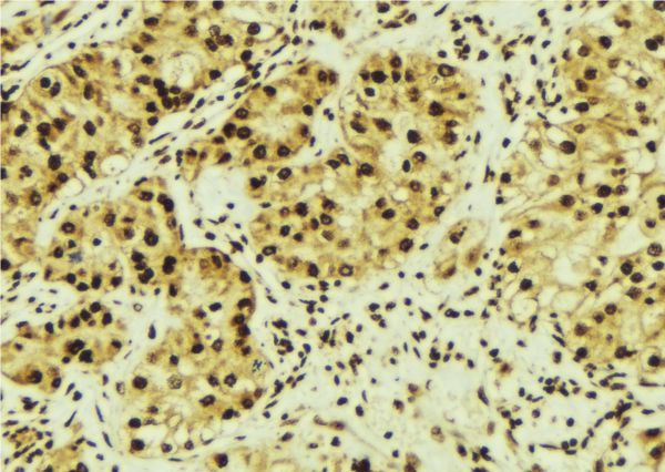 MAGED1 / NRAGE Antibody - 1:100 staining human breast carcinoma tissue by IHC-P. The sample was formaldehyde fixed and a heat mediated antigen retrieval step in citrate buffer was performed. The sample was then blocked and incubated with the antibody for 1.5 hours at 22°C. An HRP conjugated goat anti-rabbit antibody was used as the secondary.