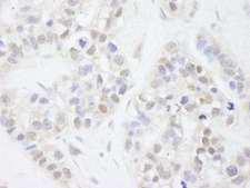 MAGED2 Antibody - Detection of Human MAGED2 by Immunohistochemistry. Sample: FFPE section of human breast carcinoma. Antibody: Affinity purified rabbit anti-MAGED2 used at a dilution of 1:250.