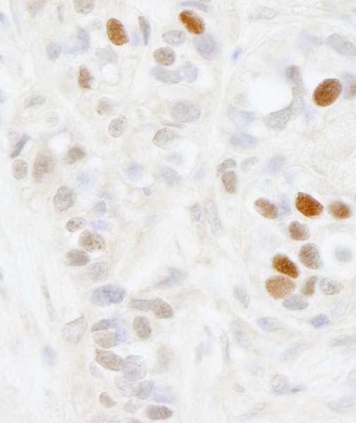 MAGED2 Antibody - Detection of Human MAGED2 by Immunohistochemistry. Sample: FFPE section of human breast carcinoma. Antibody: Affinity purified rabbit anti-MAGED2 used at a dilution of 1:250.