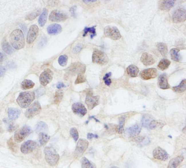 MAGED2 Antibody - Detection of Human MAGED2 by Immunohistochemistry. Sample: FFPE section of human breast carcinoma. Antibody: Affinity purified rabbit anti-MAGED2 used at a dilution of 1:200 (1 Detection: DAB.