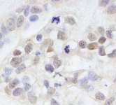 MAGED2 Antibody - Detection of Human MAGED2 by Immunohistochemistry. Sample: FFPE section of human breast carcinoma. Antibody: Affinity purified rabbit anti-MAGED2 used at a dilution of 1:200 (1 Detection: DAB.