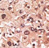 MAGEF1 Antibody - Formalin-fixed and paraffin-embedded human cancer tissue reacted with the primary antibody, which was peroxidase-conjugated to the secondary antibody, followed by AEC staining. This data demonstrates the use of this antibody for immunohistochemistry; clinical relevance has not been evaluated. BC = breast carcinoma; HC = hepatocarcinoma.
