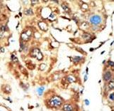 MAGI1 Antibody - Formalin-fixed and paraffin-embedded human cancer tissue reacted with the primary antibody, which was peroxidase-conjugated to the secondary antibody, followed by AEC staining. This data demonstrates the use of this antibody for immunohistochemistry; clinical relevance has not been evaluated. BC = breast carcinoma; HC = hepatocarcinoma.